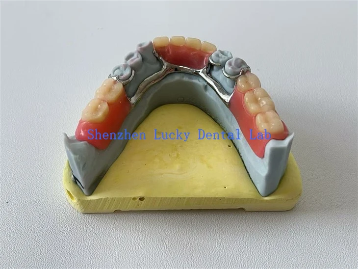 Lingual Bar Üreticileri ile Uygun Fiyatlı 3D Baskı Dental Metal Çerçevesi