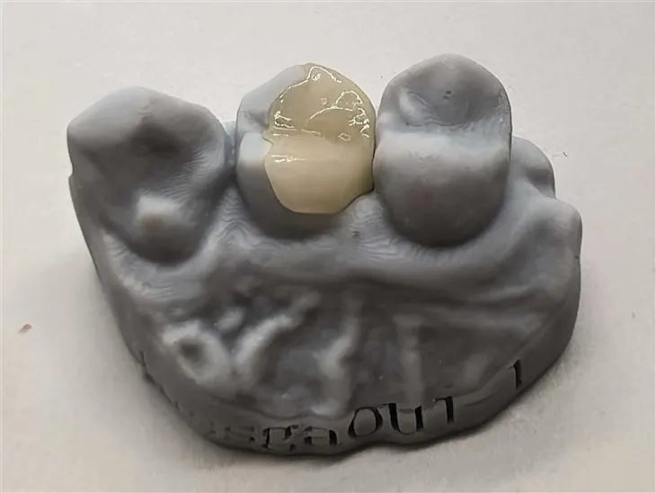 Daha İyi Bir Fiyata Otantik Kompozit Onlay